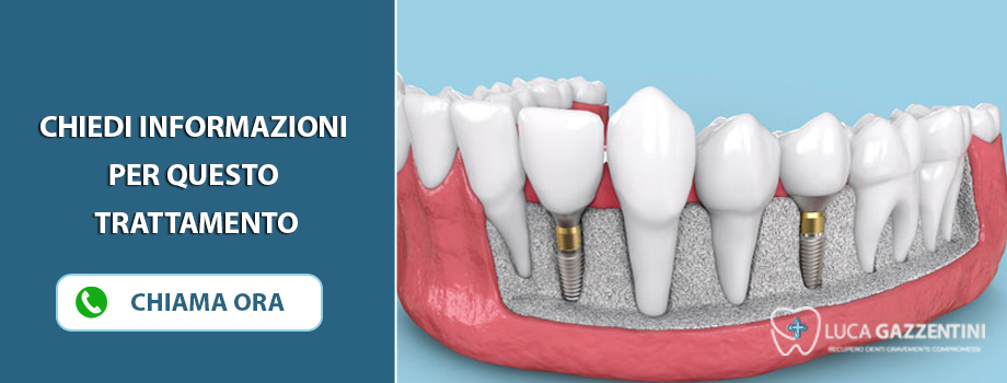 capsule-zirconia-viareggio
