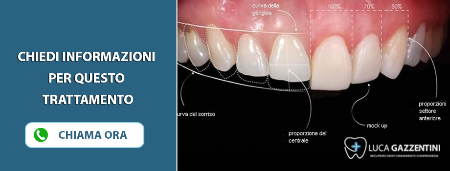 faccette-estetiche-viareggio